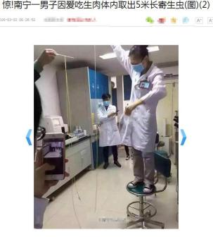 吃生肉体内取出5米长牛带绦虫