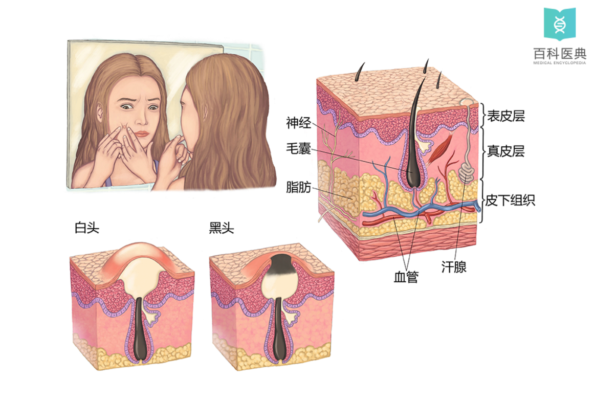 痤疮的症状