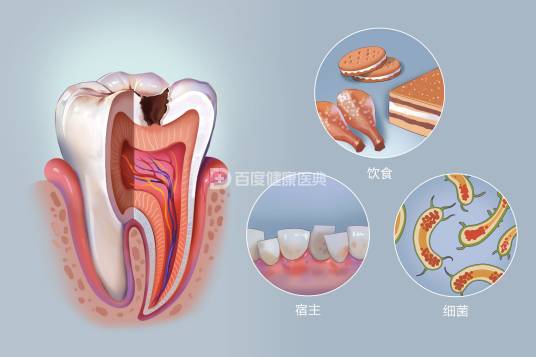 龋病 龋病