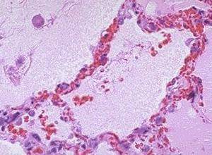 粉红色泡沫样痰 粉红色泡沫样痰