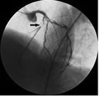 冠状动脉狭窄造影（箭头充盈缺损处为狭窄）