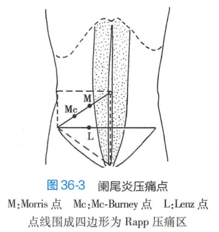 阑尾炎压痛点
