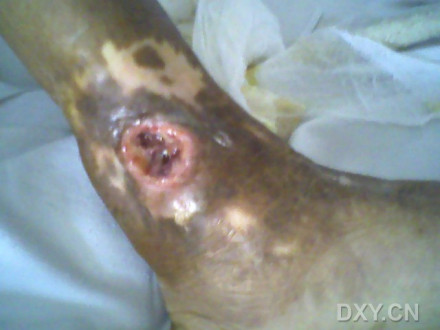 皮肤溃疡