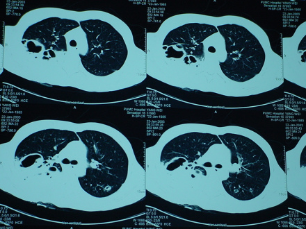 右肺炎症及脓腔