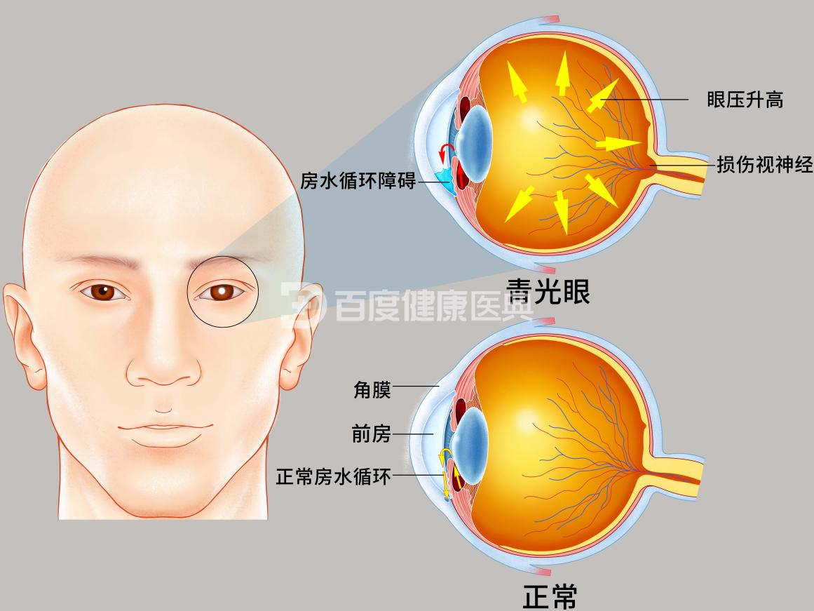 青光眼的症状