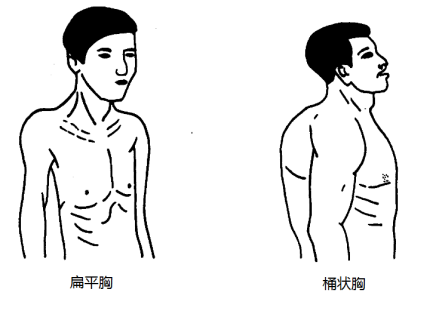 扁平胸、桶状胸