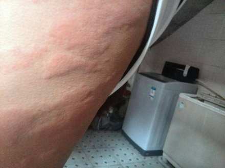 皮肤过敏症状
