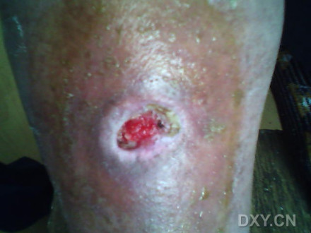 皮肤溃疡