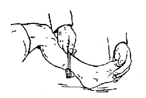 跟腱反射